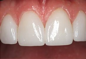 Hillcrest Dental Arts | Teeth Whitening, Crowns amp Caps and Dental Bridges