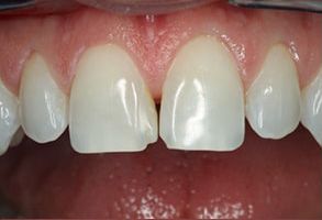 Hillcrest Dental Arts | Cosmetic Dentistry, Extractions and Icon reg Resin Infiltration